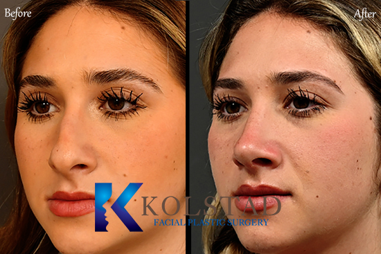 Patient undergoing ultrasonic rhinoplasty procedure at a cosmetic surgery clinic in San Diego.