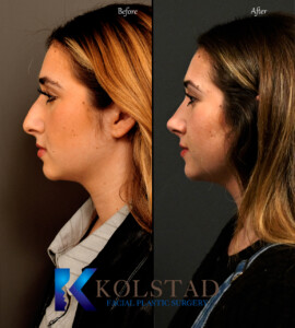 Dr. Kolstad performing ultrasonic rhinoplasty using piezoelectric technology to reshape the nose.