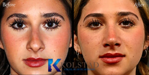 Dr. Kolstad performing ultrasonic rhinoplasty with piezoelectric tools at a cosmetic clinic in California.