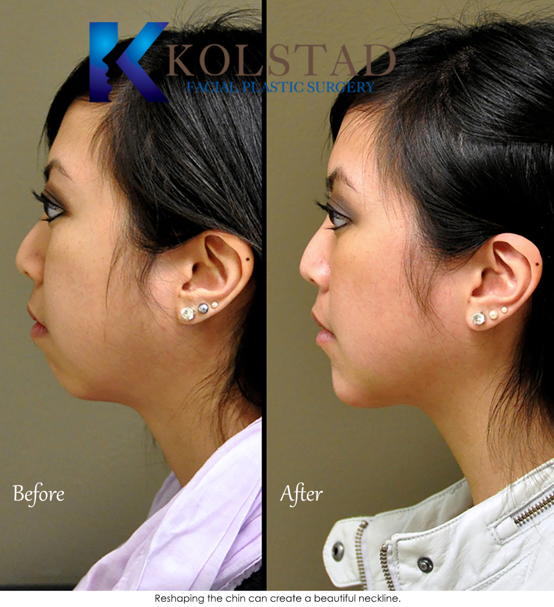 asian chin augmentation 15