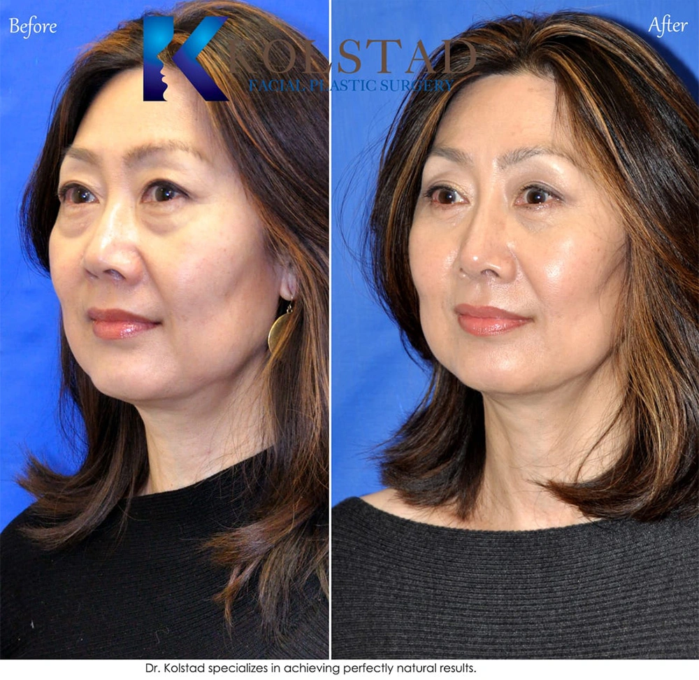 Real Patients Results of Dr. Kolstad of Kolstad Plastic Surgery serving San Diego & La Jolla, CA