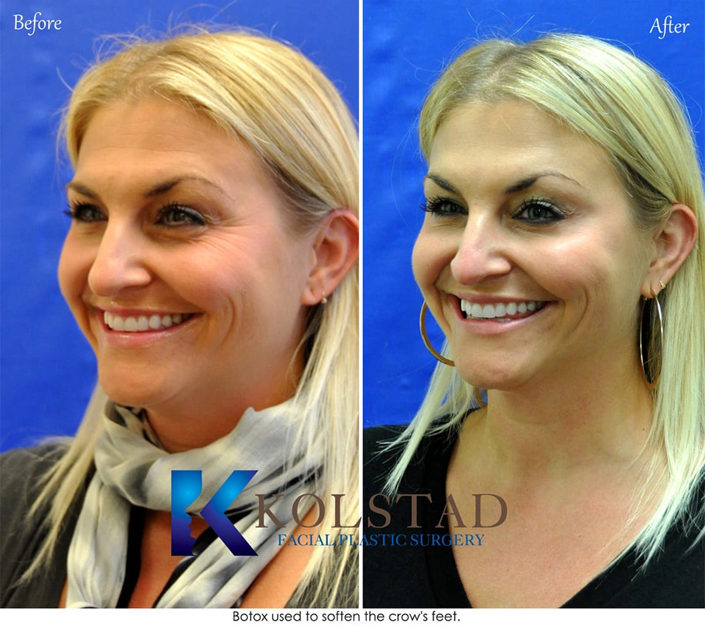 http://botox-crows-feet-san-diego-45-copy