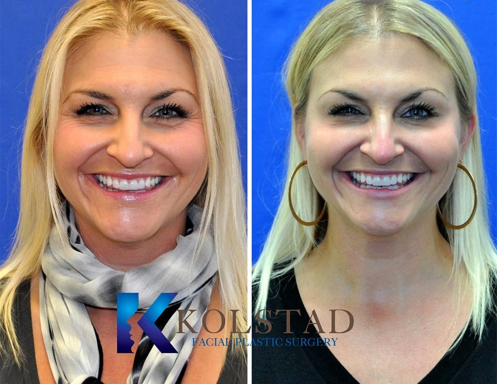 Real Patients Results of Dr. Kolstad of Kolstad Plastic Surgery serving San Diego & La Jolla, CA