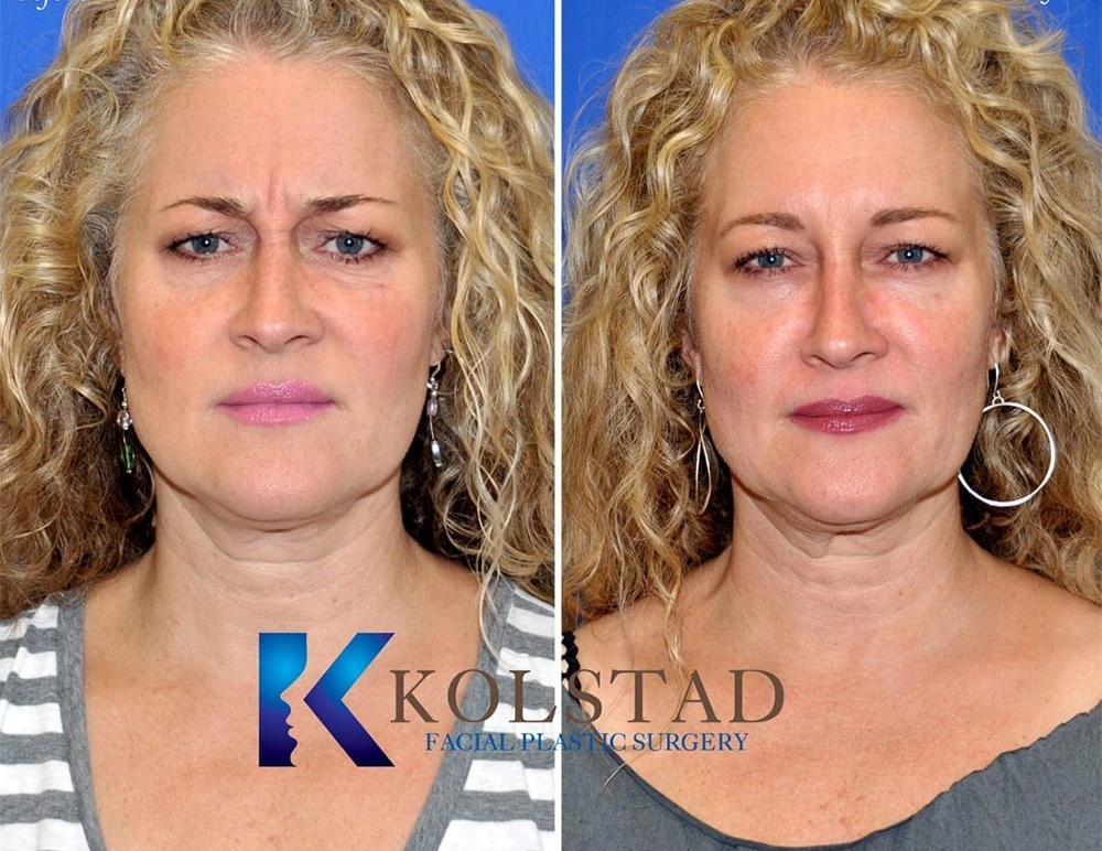Real Patients Results of Dr. Kolstad of Kolstad Plastic Surgery serving San Diego & La Jolla, CA