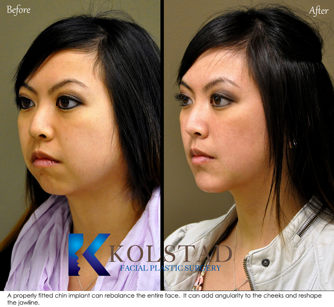 chin augmentation for asians
