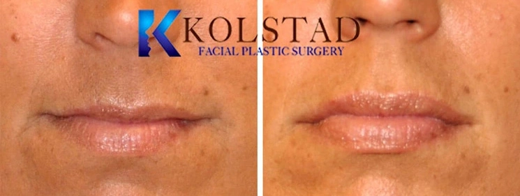 Real Patients Results of Dr. Kolstad of Kolstad Plastic Surgery serving San Diego & La Jolla, CA