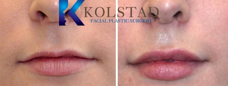 Real Patients Results of Dr. Kolstad of Kolstad Plastic Surgery serving San Diego & La Jolla, CA