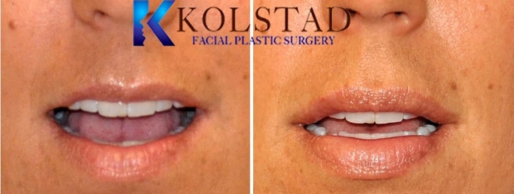Real Patients Results of Dr. Kolstad of Kolstad Plastic Surgery serving San Diego & La Jolla, CA