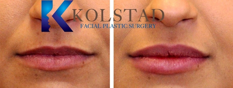 Real Patients Results of Dr. Kolstad of Kolstad Plastic Surgery serving San Diego & La Jolla, CA