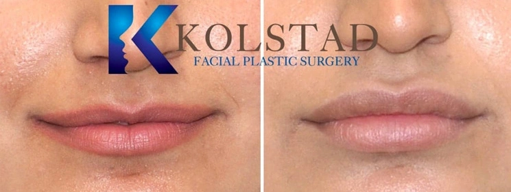 Real Patients Results of Dr. Kolstad of Kolstad Plastic Surgery serving San Diego & La Jolla, CA