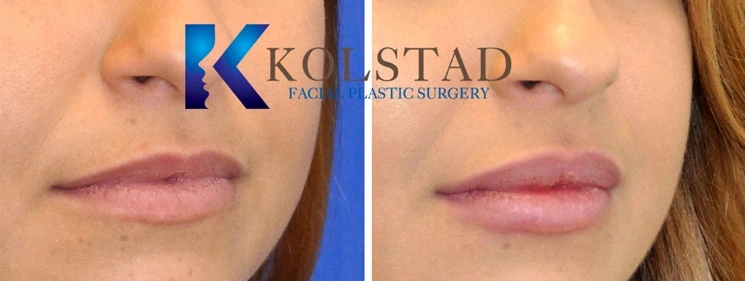 Real Patients Results of Dr. Kolstad of Kolstad Plastic Surgery serving San Diego & La Jolla, CA