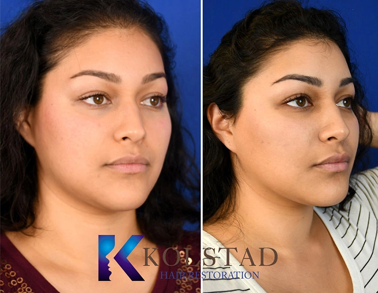 Real Patients Results of Dr. Kolstad of Kolstad Plastic Surgery serving San Diego & La Jolla, CA