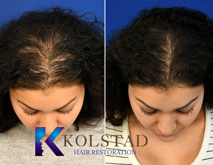 Real Patients Results of Dr. Kolstad of Kolstad Plastic Surgery serving San Diego & La Jolla, CA