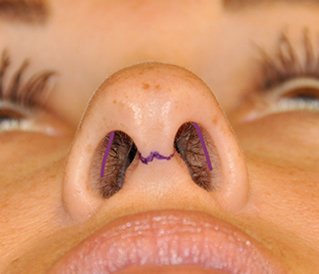 http://rhinoplasty-incision