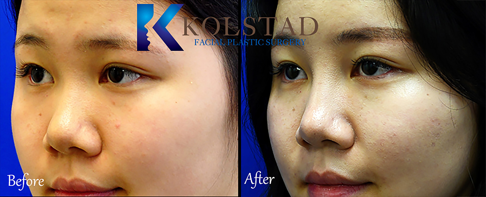 Before and after Asian rhinoplasty showing natural nasal refinement and improved facial harmony while preserving the patient's unique features in San Diego.