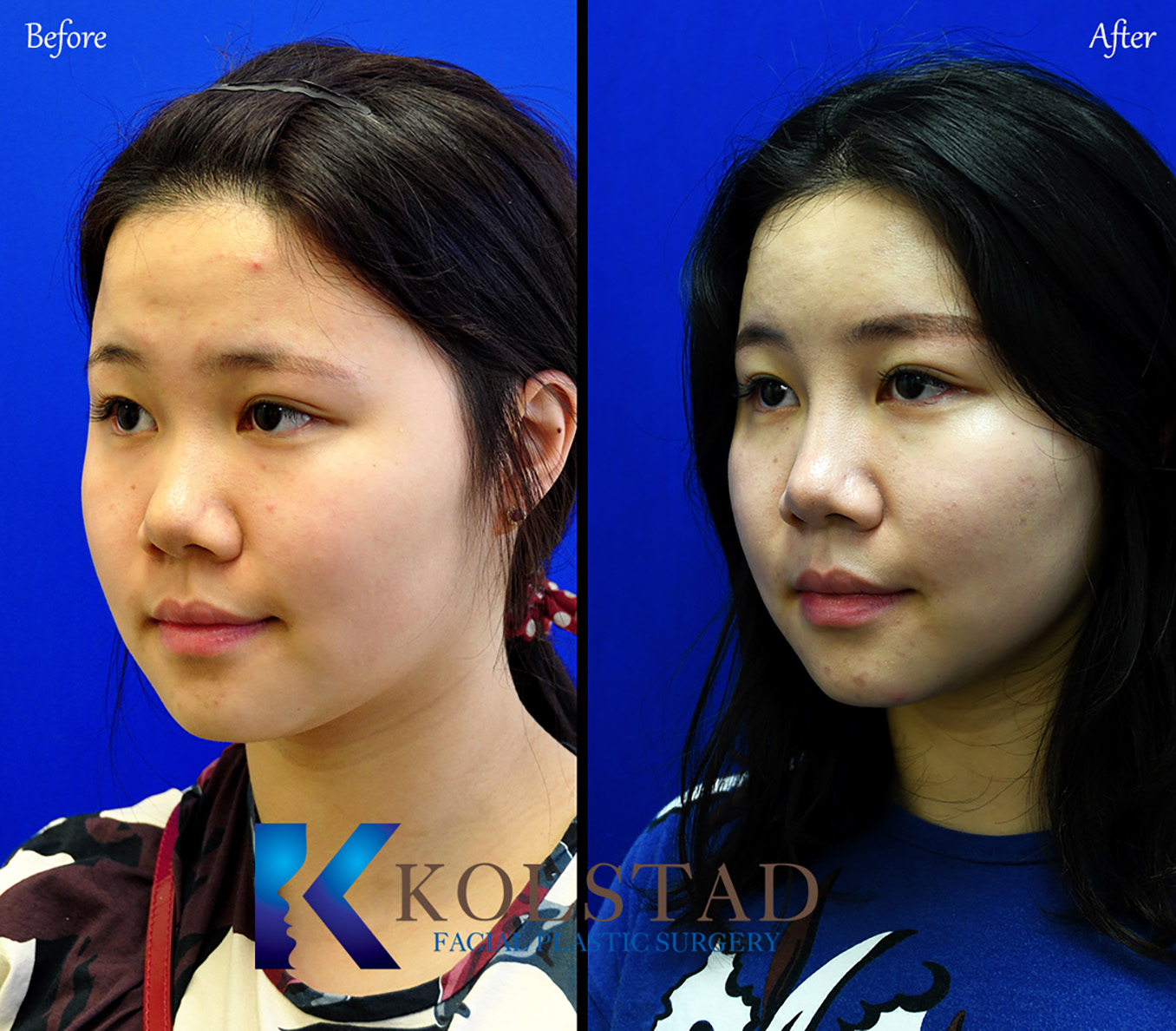 Before and after Asian rhinoplasty showing natural nasal refinement and enhanced facial harmony while preserving the patient's ethnic features in San Diego.