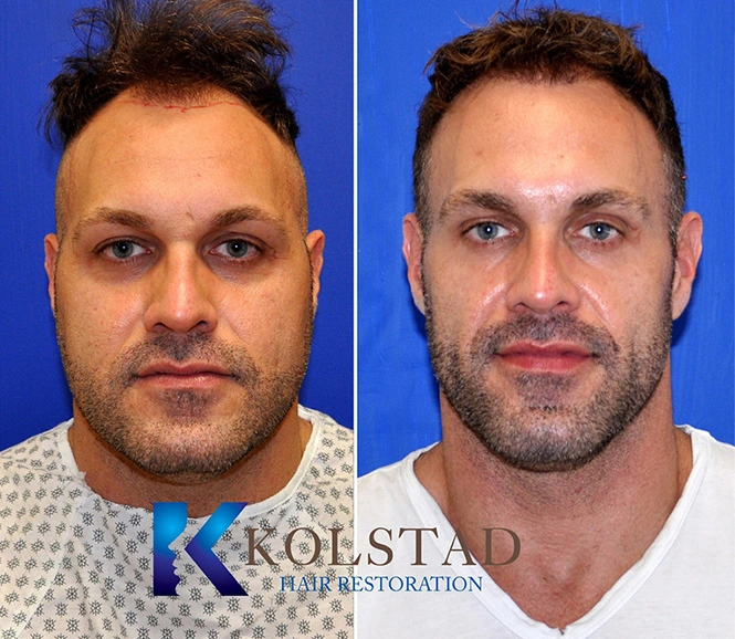Real Patients Results of Dr. Kolstad of Kolstad Plastic Surgery serving San Diego & La Jolla, CA