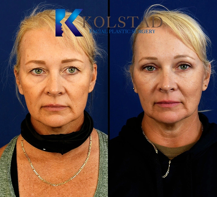 Real Patients Results of Dr. Kolstad of Kolstad Plastic Surgery serving San Diego & La Jolla, CA