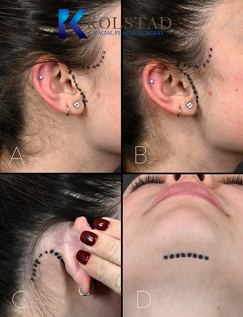 Dr. Kolstad's incisions for a facelift.