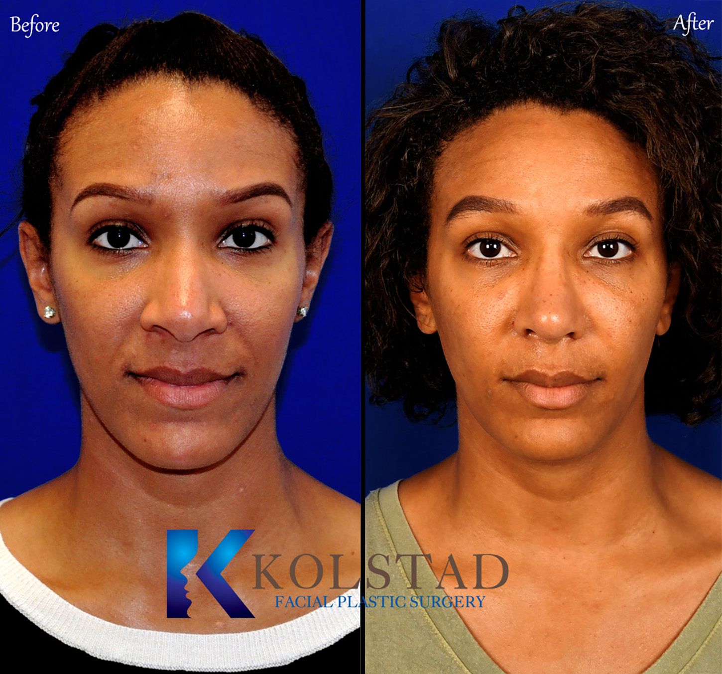 Before and after African American rhinoplasty showing refined nasal contours and improved facial balance in San Diego, California.