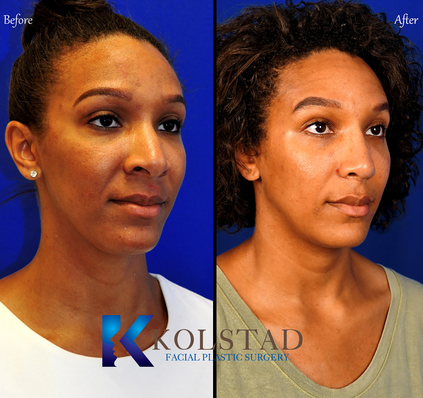 Before and after African American rhinoplasty showing refined nasal contours and improved facial balance in San Diego, California.