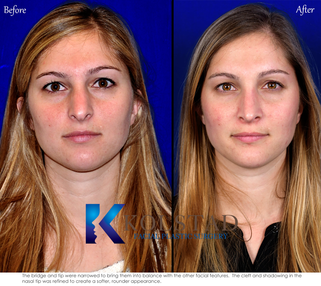Before and after rhinoplasty showing refined nasal contours and improved facial balance in San Diego, California.