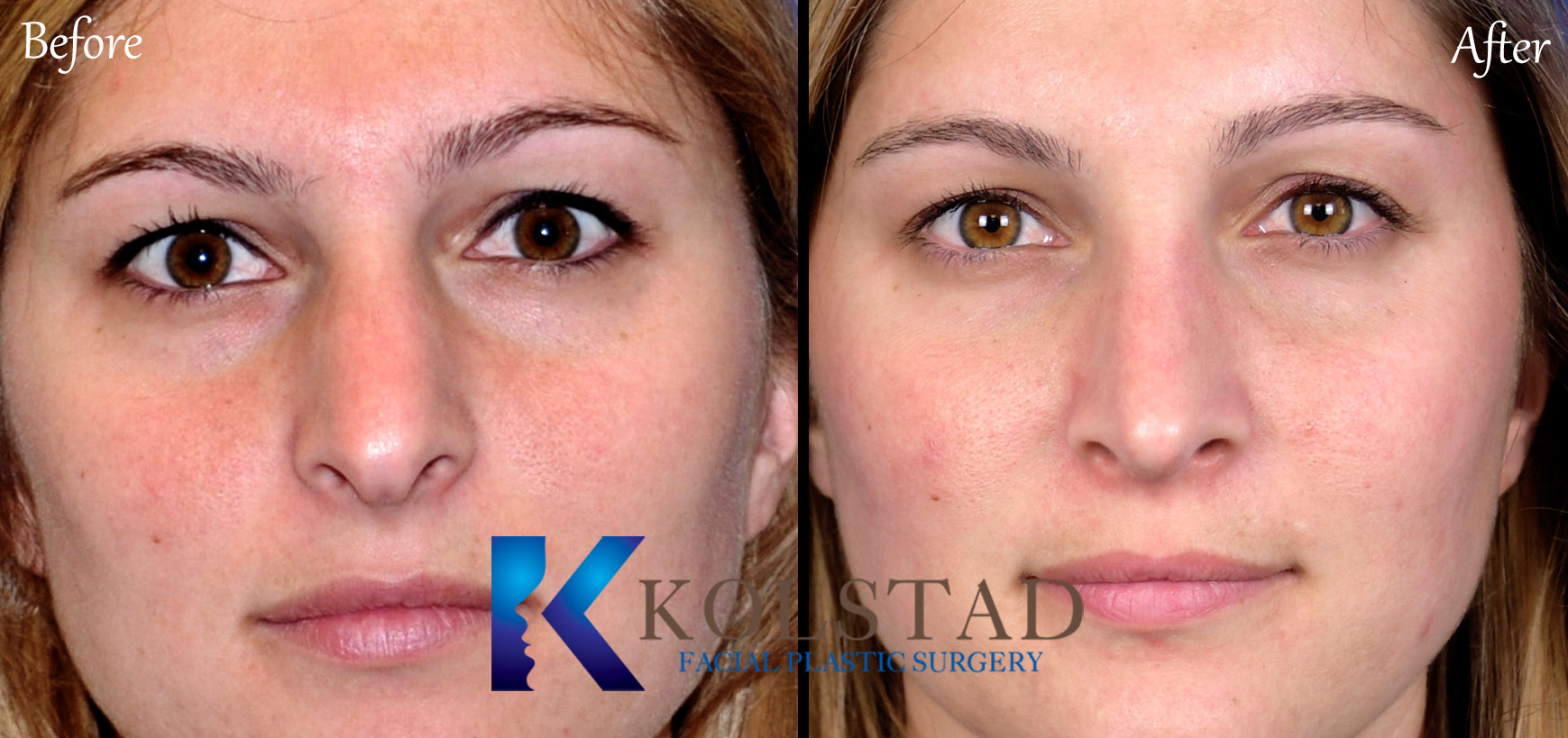 Before and after rhinoplasty showing refined nasal contours and improved facial balance in San Diego, California.