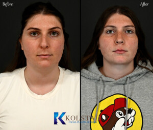 Before and after best preservation rhinoplasty in Los Angeles showing natural nasal contour refinement