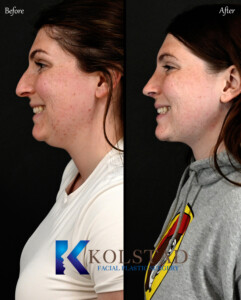 Patient results from the best preservation rhinoplasty in San Diego showing natural nose contour and minimal swelling