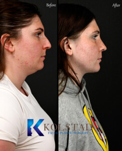 Before and after results of preservation rhinoplasty showing natural nose reshaping