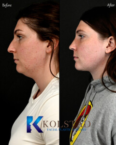 Preservation Rhinoplasty in San Diego