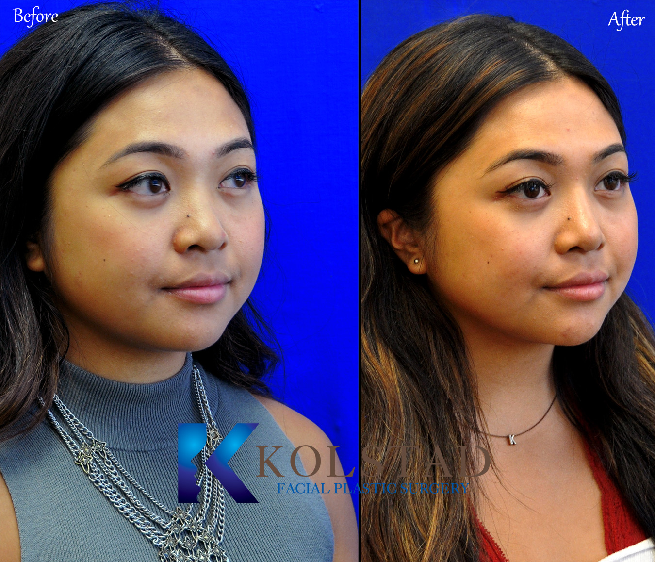 Female Asian Rhinoplasty San Diego