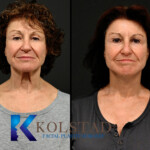 Deep plane facelift surgery performed by a San Diego facial plastic surgeon