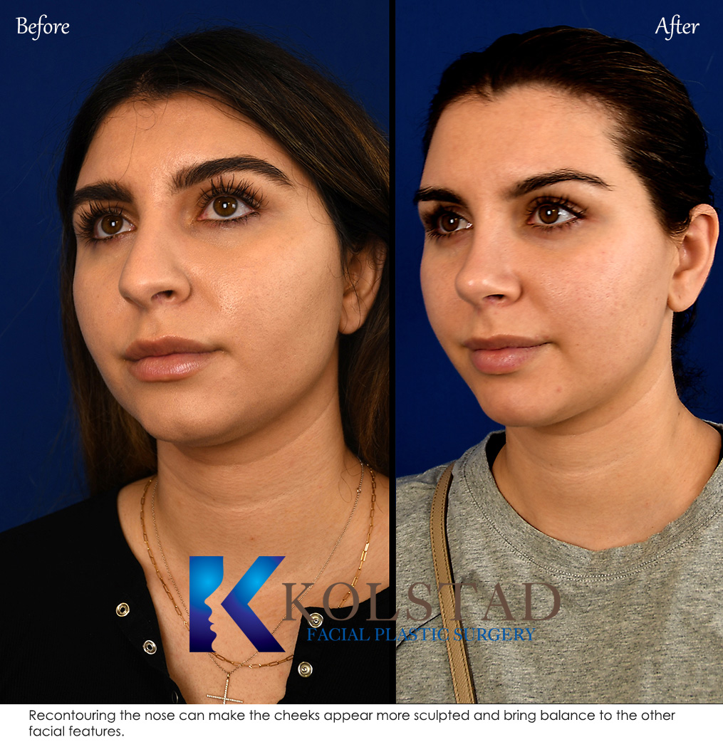 Before and after Middle Eastern nose job showing refined nasal bridge and tip for the best results