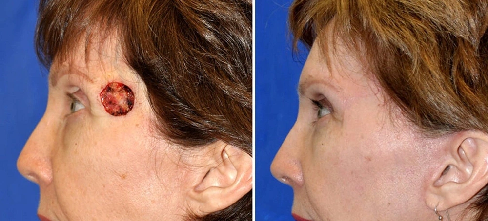 Mohs skin cancer closure before and after showing facial wound repair in San Diego, California