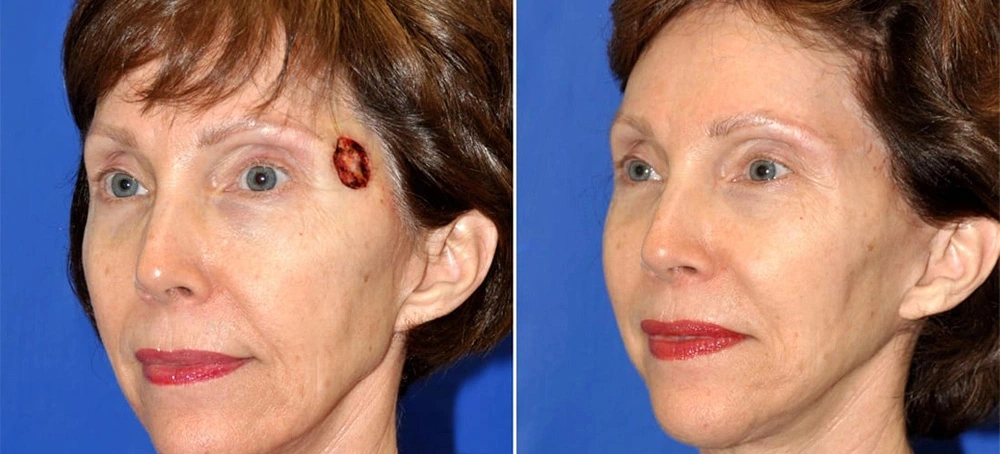 Mohs skin cancer closure before and after showing the healing of a treated area on the face in San Diego