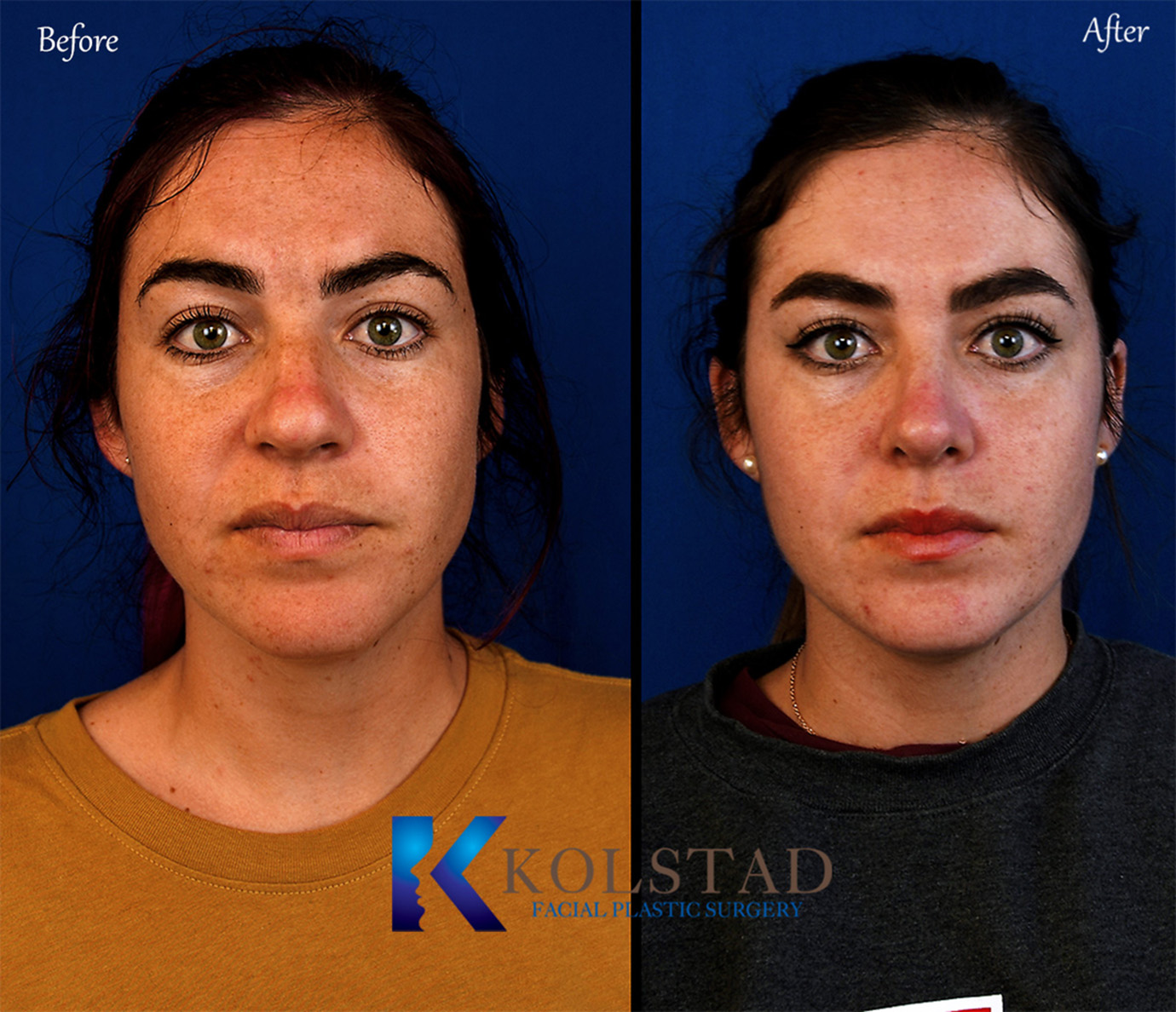 La Jolla nose job results with smooth nasal bridge and refined tip