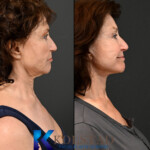 San Diego deep plane facelift surgeon specializing in advanced facial rejuvenation procedures