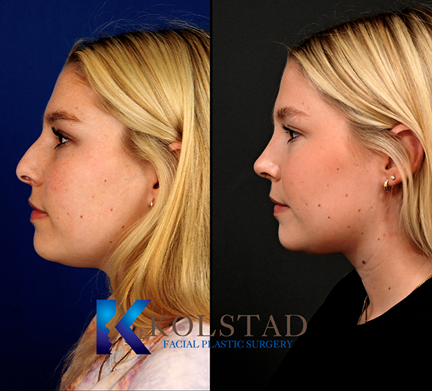 San Diego rhinoplasty before and after showing a refined and balanced nose in La Jolla, California