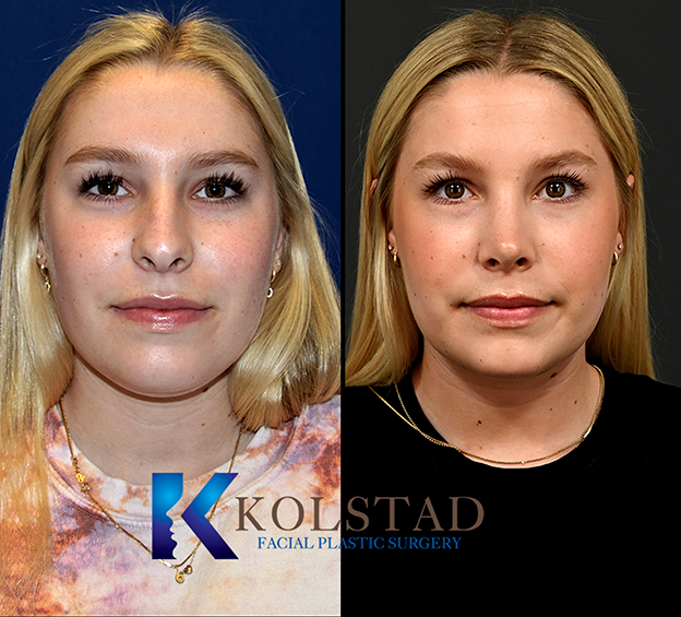 San Diego rhinoplasty before and after profile view showing a refined nasal shape and balanced facial proportions