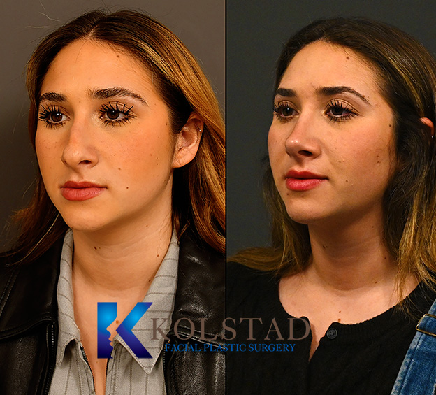 Before and after ultrasonic rhinoplasty in La Jolla showing smoother nasal bridge, refined tip shape, and improved profile alignment