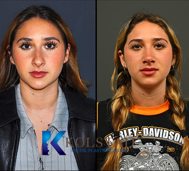Before and after ultrasonic rhinoplasty in San Diego showing refined nasal bridge, improved symmetry, and smoother profile contour