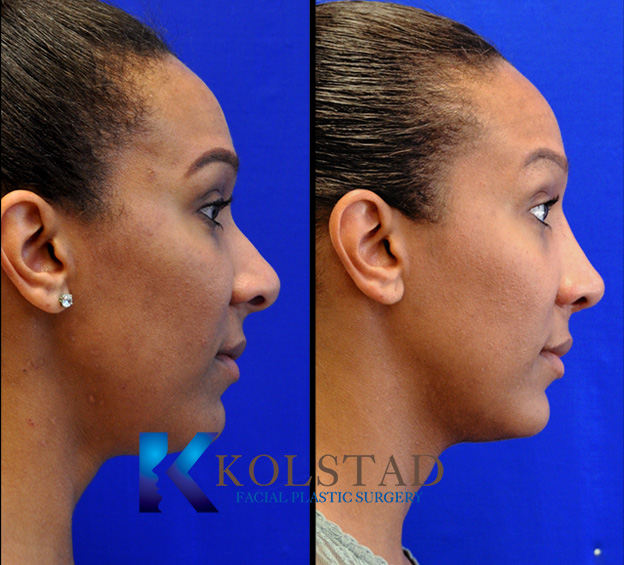Before and after African American rhinoplasty in La Jolla showing refined nasal bridge, improved tip definition, and balanced facial profile