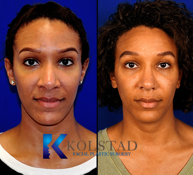 Before and after African American rhinoplasty in California showing refined nasal bridge, improved tip definition, and balanced facial profile