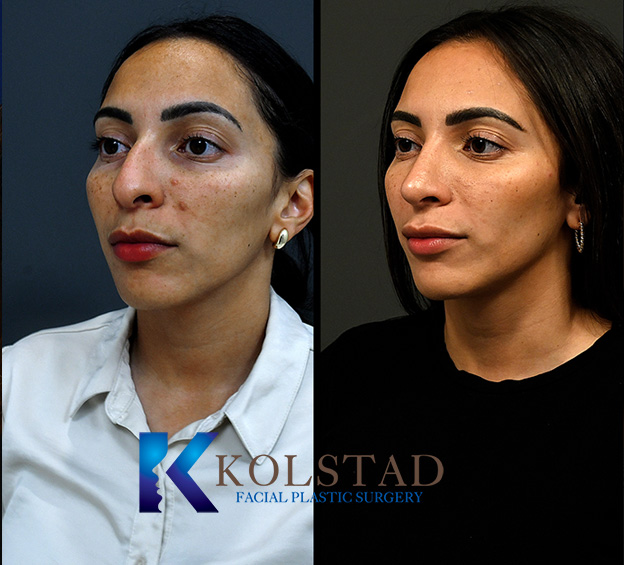 Before and after Hispanic rhinoplasty in California showing improved nasal contour, refined tip projection, and balanced facial profile