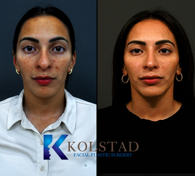 Before and after Hispanic rhinoplasty in San Diego showing improved nasal bridge contour and refined tip with a natural profile view