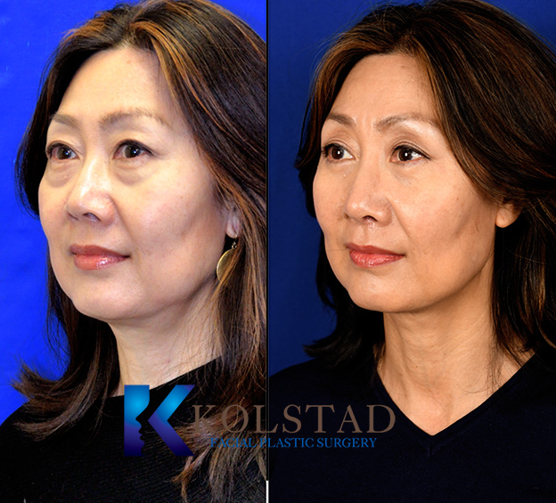 Before and after Asian rhinoplasty in San Diego showing enhanced nasal bridge contour and improved tip definition with natural facial balance
