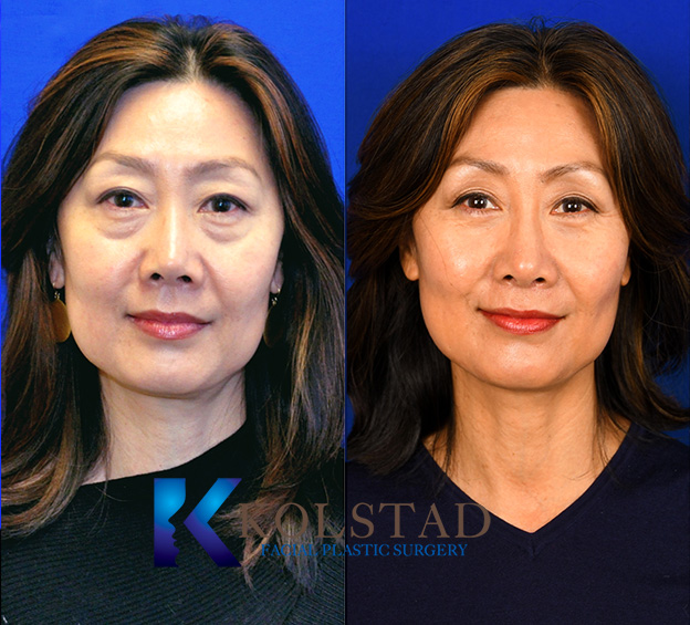 Before and after Asian nose surgery in La Jolla showing smoother nasal bridge, refined tip shape, and improved facial balance