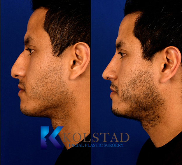 Before and after male rhinoplasty in San Diego showing refined nasal bridge, improved symmetry, and a more balanced male facial profile