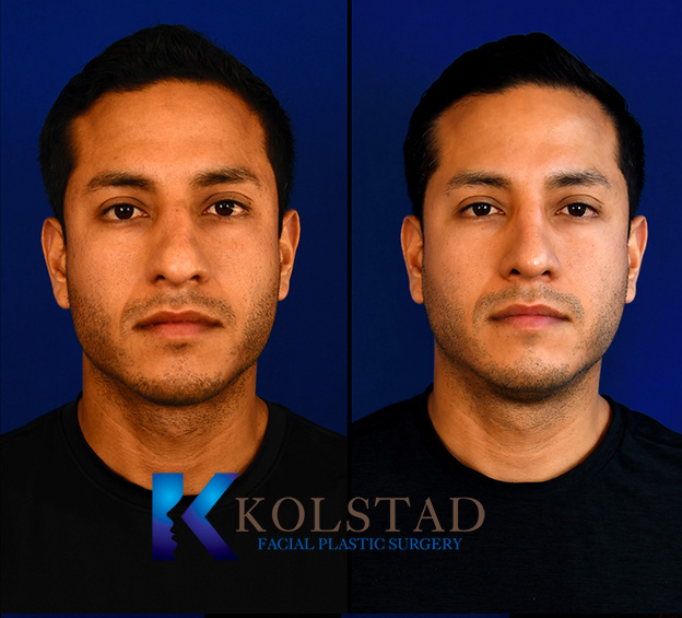 Before and after male rhinoplasty in California showing refined nasal contour, improved bridge smoothness, and balanced facial proportions